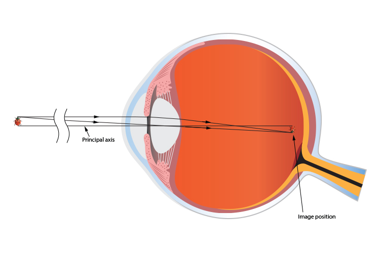 Distant blurry image on retina of short sighted person